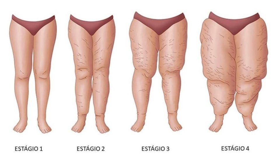 Lipedema ou só uma Celulite?